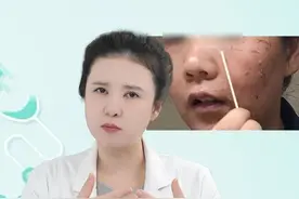 脱皮祛斑的后果和危害都有哪些？ #祛斑 #淡斑 #黑色素提取 #皮肤美容 #硬核健康科普行动视频封面