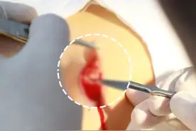 这种肉粒你还在用手剪掉吗？ #皮赘 #医学科普 #手术日常 #皮肤 #硬核健康科普行动