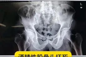 股骨头坏死不同片子 #骨坏死 #健康视频封面