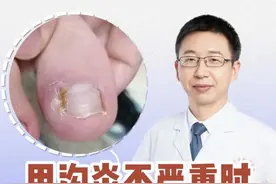 甲沟炎不严重，自己在家都可以处理 快看这个视频，就不要来医院啦~#甲沟炎 #甲沟炎正规处理 #硬核健康科普行动  #健康冷知识知多少视频封面