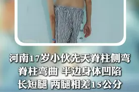 17岁小伙先天性脊柱侧弯，骨盆倾斜，两腿相差15CM #先天性脊柱侧弯 #脊柱侧弯视频封面