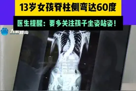 13岁女孩脊柱侧弯达60度，医生提醒：要多关注孩子坐姿站姿！#媒体精选计划视频封面