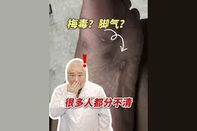 这不是脚气！这居然是 #梅毒 ！这也不是脚气 ，而是#湿疹 ！你可别认错#糜烂型脚气 ，白费功夫还耽误治疗！#硬核健康科普行动  #入冬换季不患疾视频封面