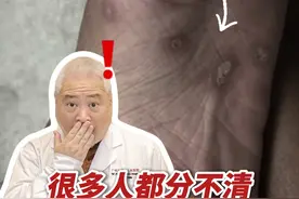这不是脚气！这居然是 #梅毒 ！这也不是脚气 ，而是#湿疹 ！你可别认错#糜烂型脚气 ，白费功夫还耽误治疗！#硬核健康科普行动  #入冬换季不患疾视频封面