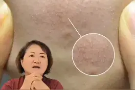 脸上的疙疙瘩瘩是什么怎么办？皮肤科医生一条视频讲清楚！#闭口  #黑头  #科普  #护肤  #抖出健康知识宝藏视频封面