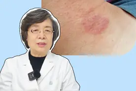 受委屈、生闷气就容易得#神经性皮炎 ，不想用激素，试试这个方法#医学科普 #健康 #皮肤 #神经性皮炎总是反复发作怎么办视频封面