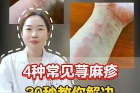 4种常见荨麻疹，一条视频教你处理 #医学科普 #皮肤 #荨麻疹 #荨麻疹的痛苦 #痒视频封面