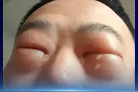 #男子首次尝试吃虫蛹肿成悲伤蛙  近日，一男子出于好奇尝试了吃虫蛹，没想到引发了严重过敏，面部肿胀神似“悲伤蛙”。据悉，高蛋白过敏时常发生在高蛋白食物摄入后，典型症状包括皮肤红肿、腹泻、哮喘等；此类过敏人群要谨慎品尝油炸“知了猴”、油炸蚂蚱等特色美食。#谈谈新知  #半月谈