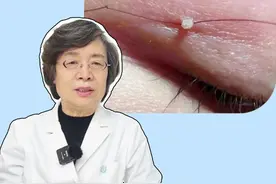 脖子、腋下或眼皮上长这种小肉条，别揪！可能是#丝状疣，会传染#医学科普#健康#涨知识#皮肤视频封面