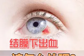 单纯的结膜下出血该如何处理？ #结膜下出血 #眼科 #济南视频封面