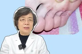 脚趾或脚底长很痒的小水泡，这是真菌感染的表现，医生教你一个小妙招#医学科普 #健康 #传染 #脚气 #盐酸阿莫罗芬