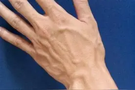 手上青筋凸起是怎么回事？是血管问题的信号吗？一起来揭秘啦#血管 #血栓 #医学科普视频封面