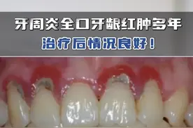 牙周炎全口牙龈红肿多年，治疗后情况良好！ #牙周炎 #牙龈红肿#种植牙  #抖出健康知识宝藏视频封面