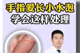 指尖指缝一换季就长小水泡，痒得钻心，记好这个处理办法#水泡 #痒 #手指脱皮 #汗疱疹 #抖出健康知识宝藏
