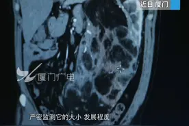 良性肿瘤放任不管，十年后竟长到6斤！患者在厦门成功手术 #厦门  #肿瘤   #肾脏错构瘤视频封面