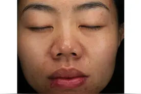 口周老是反复长痘，这套护肤步骤教会你如何处理~#护肤 #闭口粉刺 #油痘肌