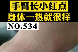 一运动或者一吃热的，就会起小红点，而且还特别痒，不要去抓啦！我们这样处理！#科普 #皮肤 #风团荨麻疹 视频封面