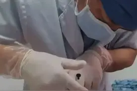 夏天到了 中医埋线减肥火爆有人埋线两次瘦十斤效果非常好!胳膊粗的也试过 轻松“躺平”“享瘦”！#健康 #科普 #中医 #减肥