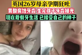 英国26岁母亲孕期狂吐，胃酸腐蚀牙齿 生完孩子牙齿掉光，现在戴假牙生活 已接受自己的样子#怀孕 #妊娠反应 #孕吐 #伟大的妈妈视频封面