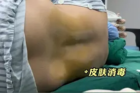 生孩子打无痛全过程揭露！8厘米的长针！好好疼自己的媳妇吧！ #无痛 #无痛分娩 #顺产 #剖腹产 #怀孕视频封面