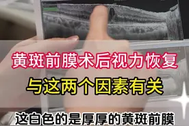 黄斑前膜术后视力恢复与这两个因素有关系#硬核健康科普行动  #黄斑前膜  #守护血糖健康指南 视频封面