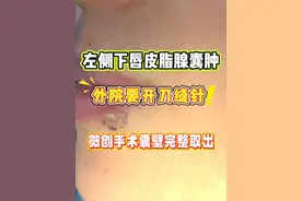 全程微创不留疤，皮脂腺囊肿彻底 say bye！ 全程微创不留疤