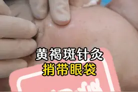 黄褐斑针灸，捎带眼袋 #黄褐斑调理 #眼袋不见了#针灸调理 #中医刘一鸣 #抖出健康知识宝藏