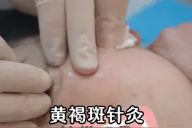黄褐斑针灸，捎带眼袋 #黄褐斑调理 #眼袋不见了#针灸调理 #中医刘一鸣 #抖出健康知识宝藏
