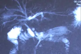 腹腔镜胆囊切除手术损伤胆管，医院伪造手术记录视频封面