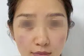 常居美国的小姐姐多次do脸，眼周衰老+垮脸+面部松弛 陈教授：苹果肌提升才靠谱 #垮脸 #眼周年轻化 #面部提升 #苹果肌提升视频封面