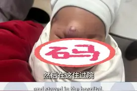 1月龄婴儿口服药物效果明显，建议随诊观察 1月龄婴儿患血管瘤，口服药物效果明显，质地变软，且红血丝减少，建议随诊观察#儿研所申刚 #血管瘤 # 在抖音pick你的健康搭子 # 解锁春日健康清单 #抖出健康知识宝藏 