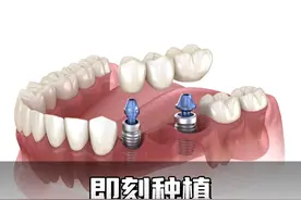 即刻种植 早期种植 延期种植 一次性讲清楚 #种植牙 #种牙 #即刻种植牙视频封面