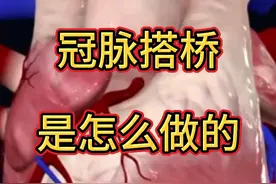 冠脉搭桥是怎么做的 常用桥血管是什么 简单易懂冠脉搭桥！#冠脉搭桥 #冠状动脉旁路移植术 #冠心病 #抖出健康知识宝藏 #内容启发搜索