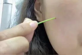女子用狗尾巴草给自己点痣，点了三天痣真的“消失”了，医生：不建议，可能会有癌变的风险视频封面