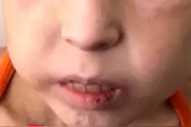 加沙儿童严重营养不良 #加沙小女孩：我想吃肉 鸡蛋 水果 #以军对加沙地带的轰炸继续 多地至少30人遇难 多为#妇女儿童视频封面