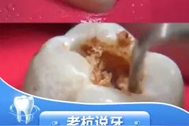 蛀牙修复全过程#口腔科普#蛀牙#解压 #修复 视频封面