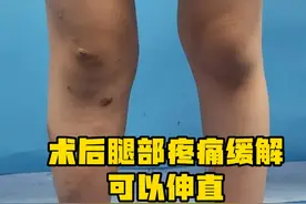 蒙古小女娃的曲折求医路（下） #kt综合征 #血管畸形 #医患故事 #硬核健康科普行动视频封面