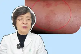 小腿又干又痒，抓完之后可能还起红疙瘩，这是#干性湿疹 ，医生教你正确处理#医学科普 #科普 #湿疹 #硬核健康科普行动