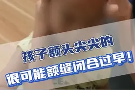 娃额头尖尖的，感觉有个棱，可能是额缝早闭！ #额缝早闭 #颅缝早闭 #医学科普 #儿童脑科小米大夫视频封面