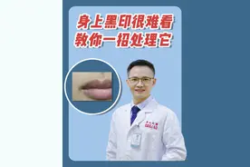 你身上有这三种黑印吗？试试这样处理它#医学科普  #黑印子  #健康视频封面