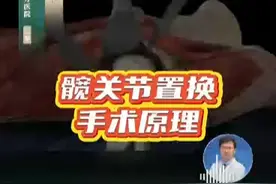 髋关节置换手术是怎么做的？ #股骨头坏死  #抖出健康知识宝藏   #内容启发搜索视频封面