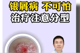 银屑病不可怕，治疗时注意要分型#银屑病 #牛皮癣 #硬核健康科普行动视频封面