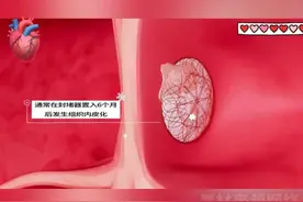 房间隔缺损封堵手术动画演示 房间隔缺损封堵手术动画演示#抖出健康知识宝藏  #情绪松绑给心灵放个假 #先心病 #房缺 #3D动画 