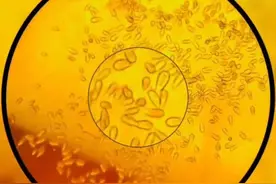 碘伏对付微生物很猛？但它真的搞不定这个传染病！#脚气 #糜烂型脚气 #烂脚丫 #硬核健康科普行动  #健康冷知识知多少