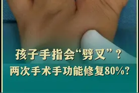 孩子手指会劈叉？ 这样的裂手畸形你肯定没见过，两次手术重建功能#医学科普 #分裂手 #并指 #手术视频封面