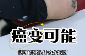 脚底黑痣会癌变吗？#黑痣 #黑痣和黑色素瘤的区别 #黑痣会癌变吗 #硬核健康科普行动 #医疗健康创作训练营视频封面