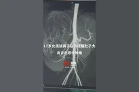 身形消瘦肚子大得不正常！17岁#女孩试裤子店员提醒肚子大查出肿瘤视频封面