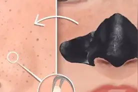 美女鼻子上长满黑头，第一视角沉浸式清理黑头，全程超级解压！视频封面