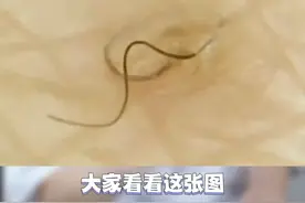 你的手上是不是也有这种密密麻麻的小疙瘩？摸起来很粗糙，这个视频可以帮到你#医学科普#dou来涨健康知识#鸡皮肤 视频封面