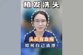 植发后如何自己清理血痂？ #发际线后移 #发际线种植 #掉发 #杭州植发汤宋佳 #公立三甲